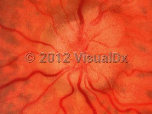 Clinical image of Idiopathic intracranial hypertension - imageId=6552628. Click to open in gallery. 