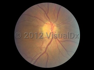Clinical image of Anterior ischemic optic neuropathy - imageId=6554314. Click to open in gallery. 