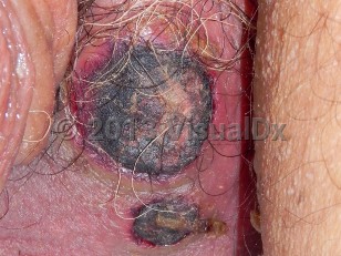 Clinical image of ATRA-induced genital ulcer - imageId=6555968. Click to open in gallery.  caption: 'A close-up of eschars with surrounding erythema on the scrotum.'