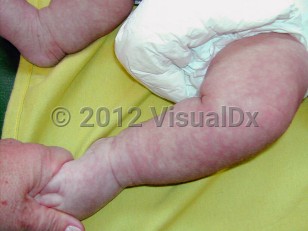 Clinical image of Macrocephaly-capillary malformation - imageId=6558403. Click to open in gallery.  caption: 'Reticulate and mottled patches and plaques on the legs.'