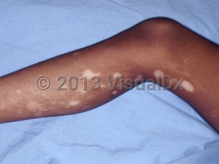 Clinical image of Segmental vitiligo