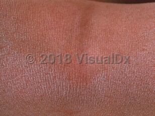Clinical image of X-linked ichthyosis