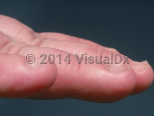 Clinical image of Koilonychia - imageId=659299. Click to open in gallery.  caption: 'Concave fingernails with central depressions and everted edges. Onychorrhexis is also present.'