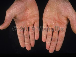 Clinical image of Palmoplantar keratoderma - imageId=659586. Click to open in gallery.  caption: 'Diffuse marked hyperkeratosis of bilateral palms with focal thickening around finger joints and distal palms.'