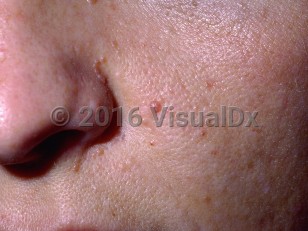Clinical image of Tuberous sclerosis - imageId=66056. Click to open in gallery.  caption: '"Adenoma sebaceum" (cutaneous angiofibromas) of tuberous sclerosis manifesting as several tiny pink and light brown papules on the nose and cheek.'