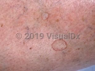 Clinical image of Disseminated superficial actinic porokeratosis