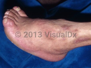Clinical image of Poliomyelitis - imageId=6631792. Click to open in gallery. 