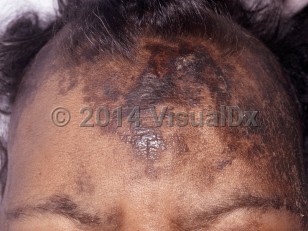 Clinical image of Dermatosis neglecta