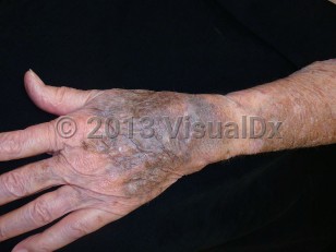Clinical image of Amiodarone drug-induced pigmentation