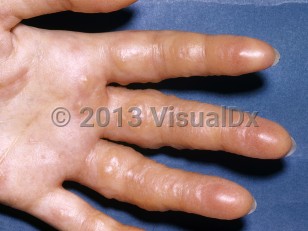 Clinical image of Vesicant exposure