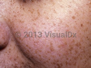 Clinical image of Ephelides - imageId=6736522. Click to open in gallery. 