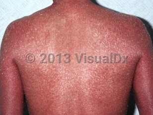 Clinical image of Congenital non-bullous ichthyosiform erythroderma