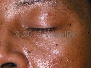 Clinical image of Dermatosis papulosa nigra