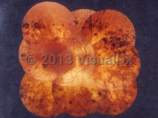 Clinical image of Retinitis pigmentosa - imageId=6769507. Click to open in gallery. 