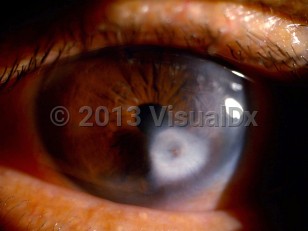 Clinical image of Peters anomaly - imageId=6790350. Click to open in gallery.  caption: 'A paracentral corneal scar (leukoma).'