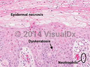 Lab image of Necrolytic acral erythema - imageId=6818816. Click to open in gallery. 