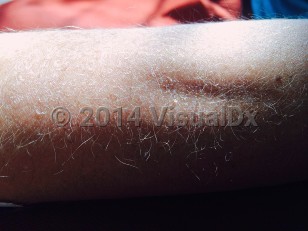 Clinical image of Anorexia nervosa - imageId=6825984. Click to open in gallery.  caption: 'Numerous fine nonpigmented hairs on the forearm.'