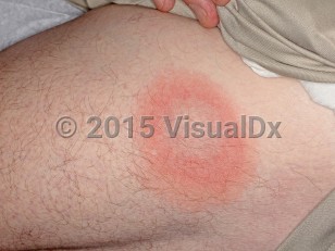 Clinical image of Southern tick-associated rash illness - imageId=6826651. Click to open in gallery.  caption: 'A targetoid erythematous plaque with a dusky center and central fine scale on the thigh.<br/><br/>Image appears with permission from East Carolina University Division of Dermatology.'