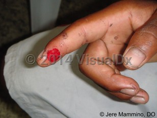 Clinical image of Piranha bite - imageId=6827484. Click to open in gallery.  caption: 'A large erosion on the distal finger.'