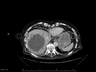 Imaging Studies image of Pyogenic liver abscess - imageId=6828400. Click to open in gallery.  caption: '<span>Axial CT image demonstrates a  large thick-walled fluid collection at the hepatic dome with mildly  enhancing peripheral rim, consistent with liver abscess.</span>'