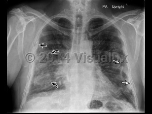 Imaging Studies image of Asbestosis - imageId=6828755. Click to open in gallery.  caption: '<span>Radiograph shows widespread pleural plaques (straight black arrow) with several plaques showing calcifications (straight white arrows) in addition to reticular opacities primarily demonstrated in the mid and lower lung zones (curved black arrows). 71 year-old male with history of asbestos exposure, presenting with acute shortness of breath. Imaging findings compatible with asbestosis.</span>'