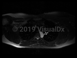 Imaging Studies image of Bronchogenic cyst - imageId=6831484. Click to open in gallery.  caption: '<span>Axial MRI image of the chest demonstrates a circumscribed lesion in the left posterior  mediastinum which is intermediate in intensity on T1 and hyperintense on  T2 consistent with a proteinaceous cyst (straight black arrow).</span>'