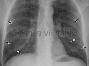 Imaging Studies image of Extrinsic allergic alveolitis - imageId=6832895. Click to open in gallery.  caption: '<span>Radiographs show hazy  opacities throughout both lungs (straight black arrows). Small, poorly  defined nodules are subtle (straight white arrows). There is relative  sparing of the lung apices. Patient is a 63 year-old male with history of exposure to birds, presenting with low-grade fever and shortness of breath.</span>'