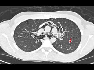 Imaging Studies image of Pneumomediastinum - imageId=6835520. Click to open in gallery.  caption: '<span>18 yo male with gradual onset chest pain. No clear precipitating event or trauma. Axial CT image of the chest demonstrates extensive mediastinal air outlining the heart, great vessels (straight white arrow), central bronchi (curved black arrow), and tracking into the neck. Interstitial emphysema is also seen (straight red arrow).</span>'