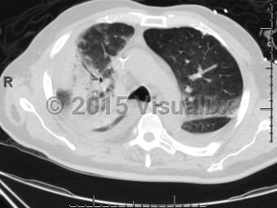 Imaging Studies image of Chlamydophila pneumoniae pneumonia