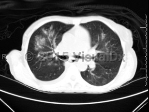 Imaging Studies image of Respiratory syncytial virus infection - imageId=6839039. Click to open in gallery.  caption: '<span>Axial CT image demonstrates bilateral (right worse than left) ground glass opacities with centrilobular nodules. Patient was positive for RSV.</span>'