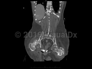 Imaging Studies image of Septic arthritis - imageId=6839247. Click to open in gallery.  caption: '<span>Coronal CT view demonstrates  large right hip joint effusion with foci of air and erosion of the  femoral head and acetabulum. Findings are consistent with septic  arthritis with associated osteomyelitis. Note that the femoral head is  dislocated due to the underlying effusion and infection.</span>'