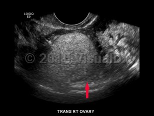 Imaging Studies image of Ovarian cysts - imageId=6839868. Click to open in gallery.  caption: 'Image from a transvaginal ultrasound demonstrating a highly echogenic mass in the right ovary, consistent with a dermoid cyst.'
