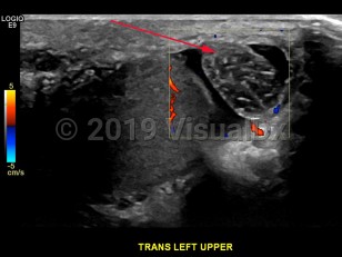Imaging Studies image of Testicular torsion