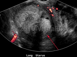 Imaging Studies image of Endometrial carcinoma