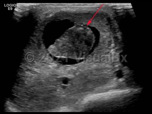 Imaging Studies image of Parotid gland carcinoma - imageId=6841392. Click to open in gallery.  caption: 'Grayscale ultrasound image of the right parotid gland demonstrating a complex partially cystic mass within the parotid gland.'