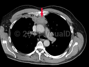 Imaging Studies image of Thymoma - imageId=6841586. Click to open in gallery.  caption: '<span>Contrast enhanced CT scan of chest with anterior mediastinal mass. <br /></span>'