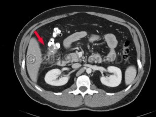 Imaging Studies image of Diverticulitis - imageId=6841976. Click to open in gallery.  caption: '<span>Axial image from CT scan of  abdomen and pelvis with wall thickening of ascending colon, with an  inflamed diverticulum consistent with diverticulitis.</span><br />'