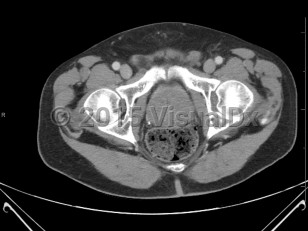 Imaging Studies image of Benign prostatic hyperplasia