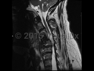 Imaging Studies image of Syringomyelia