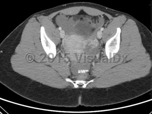 Imaging Studies image of Ectopic pregnancy - imageId=6844496. Click to open in gallery.  caption: '<span>Axial CT image demonstrates high  attenuation fluid in the pelvis consistent with blood. Patient with  subsequent positive pregnancy test, and found to have ruptured ectopic  pregnancy. </span>'