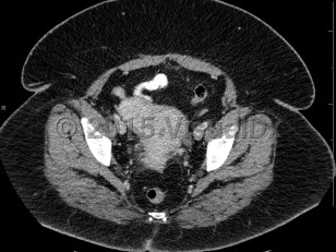 Imaging Studies image of Uterine fibroids