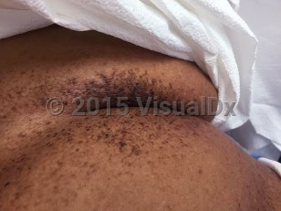 Clinical image of Galli-Galli disease - imageId=6846206. Click to open in gallery.  caption: 'Discrete and reticulated, brown macules and plaques on the breast and upper abdomen.'