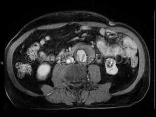 Imaging Studies image of Abdominal aortic aneurysm