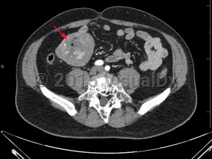 Imaging Studies image of Gastrointestinal stromal tumor - imageId=6846532. Click to open in gallery.  caption: 'Axial CT image demonstrates a large, heterogeneously enhancing mass involving the small bowel. Pathology was consistent with gastrointestinal stromal tumor (GIST).'