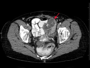 Imaging Studies image of Ovarian cancer - imageId=6846725. Click to open in gallery.  caption: '<span>Axial CT image demonstrates a  large, heterogeneous, partially solid, and cystic mass involving the left  adnexa. Biopsy results were consistent with ovarian carcinoma.</span>'