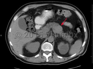 Imaging Studies image of Pancreatic carcinoma - imageId=6846876. Click to open in gallery.  caption: 'Axial non-contrast CT image demonstrates a relatively hyperattenuating mass within the body of the pancreas. Pathology was consistent with pancreatic neuroendocrine tumor.'