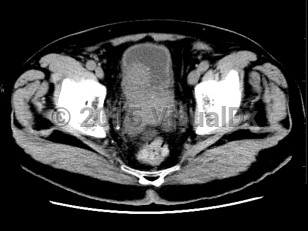 Imaging Studies image of Prostate cancer - imageId=6847001. Click to open in gallery.  caption: '<span>Axial CT image demonstrates an  enlarged, bulky prostate gland which indents the bladder wall. Biopsy  was consistent with prostate carcinoma. </span>'