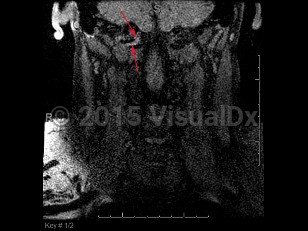 Imaging Studies image of Vertebral artery dissection - imageId=6847927. Click to open in gallery.  caption: '<span>Coronal T1 weighted image demonstrating T1 hyperintensity in the V3 segment of the right  vertebral artery. Findings are consistent with vertebral artery  dissection.</span>'