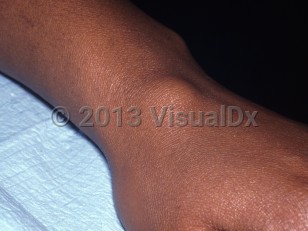 Clinical image of Ganglion cyst - imageId=6858683. Click to open in gallery.  caption: 'A flesh-colored subcutaneous nodule on the dorsal wrist.'