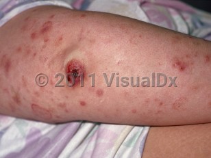 Clinical image of Lymphomatoid papulosis - imageId=68620. Click to open in gallery.  caption: 'Numerous erythematous papules and some nodules, one with a central crusted ulcer, on the arm.'